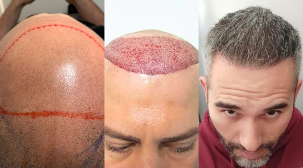 Antes y después del injerto de cabello en Tijuana